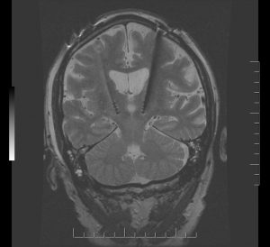 An MRI scan reveals the inside of 66-year-old Gord Luke's brain-Milenio Stadium-Ontario