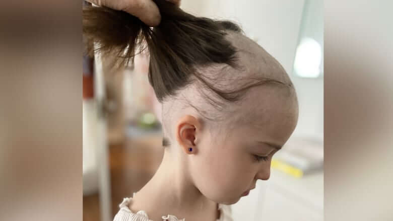 After she lost her hair from COVID-19, 7-year-old Regina girl excited for 1st vaccine dose-Milenio Stadium-Canada