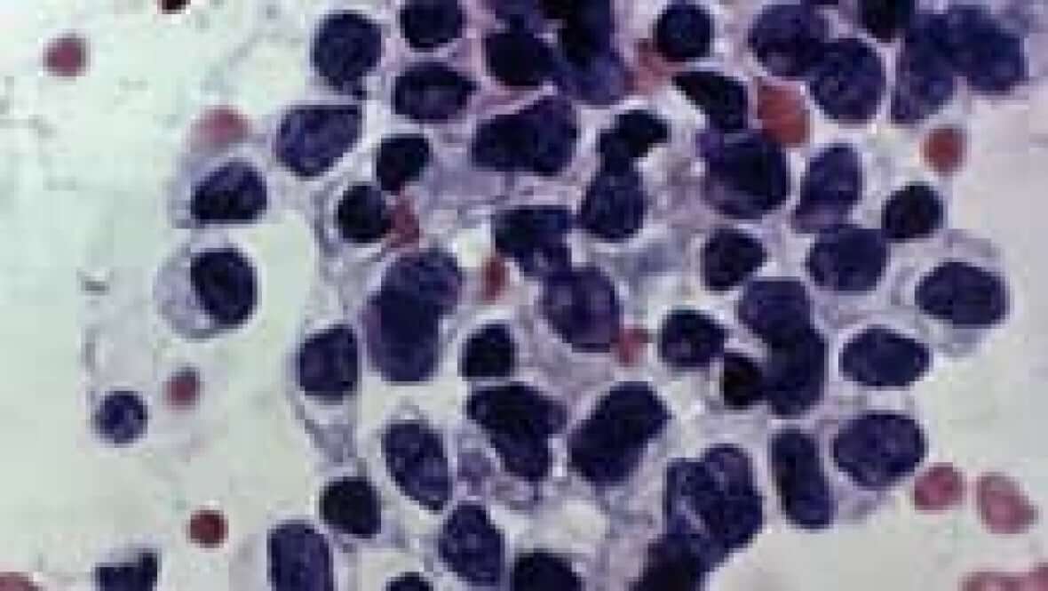 Cancerous cells detected by a pap test-Milenio Stadium-Canada